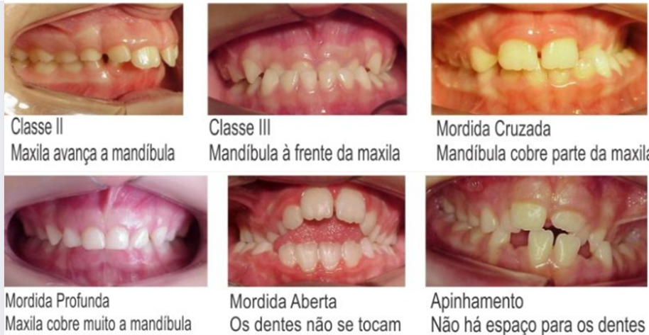 Você sabe identificar uma má oclusão em crianças? 3 cl3