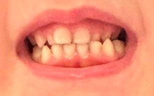 Por que algumas crianças têm o sorriso mais “apertadinho” — e por que isso precisa ser visto antes dos 6 anos