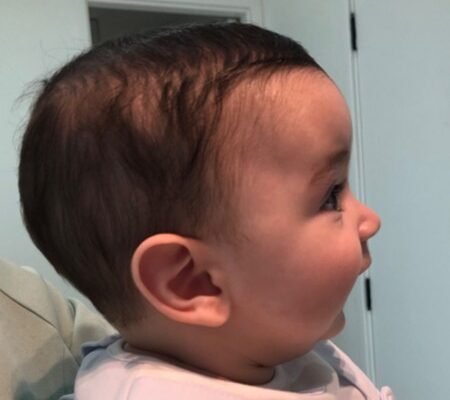 Por que avaliar o desenvolvimento facial do seu filho antes dos 6 anos faz toda a diferença