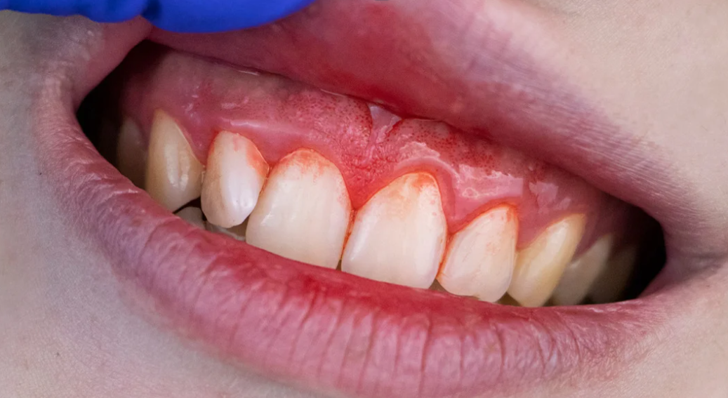 Quando a prevenção é ignorada, o dano é irreversível!